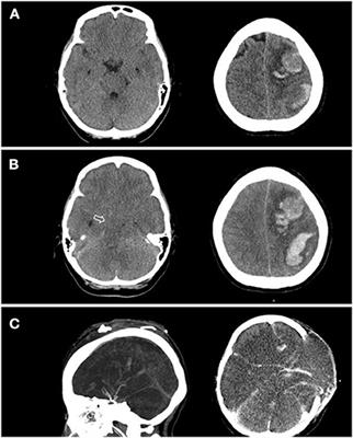 Frontiers Case Report Vaccine Induced Immune Thrombotic